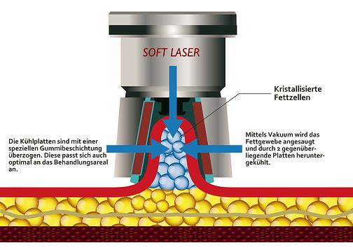 Kryolipolyse - Hightech-Methode ohne Nadeln und Schnitte